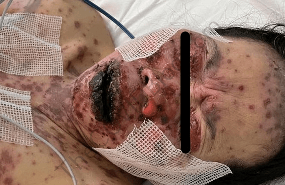 Toxic epidermal necrolysis: 49-year-old New York woman develops life-threatening skin-rotting disorder one week after Pfizer mRNA injection