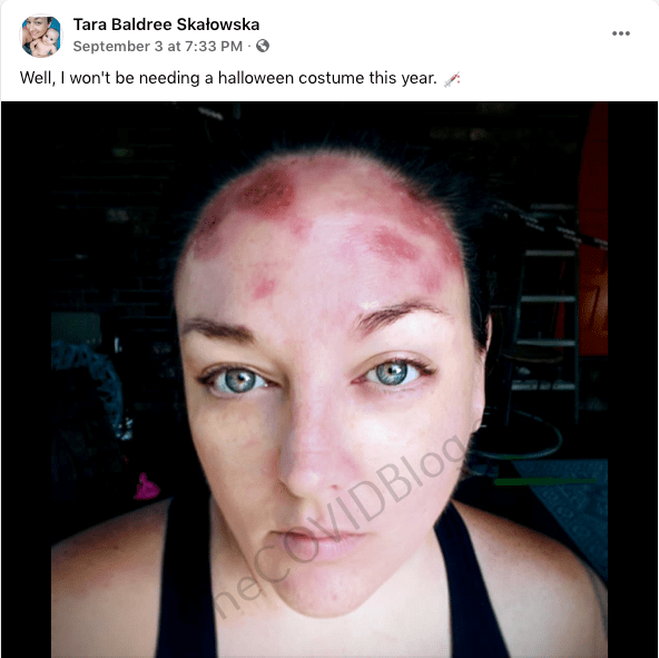 Tara Skalowska: 40-year-old Florida woman suffers skin disorder after second Moderna mRNA injection, doctors cannot help her