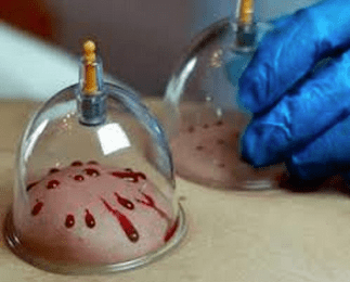 Hijama aka “cupping”: desperate workers, students forced into vaxx mandates turn to ancient treatment to remove the injections after administration